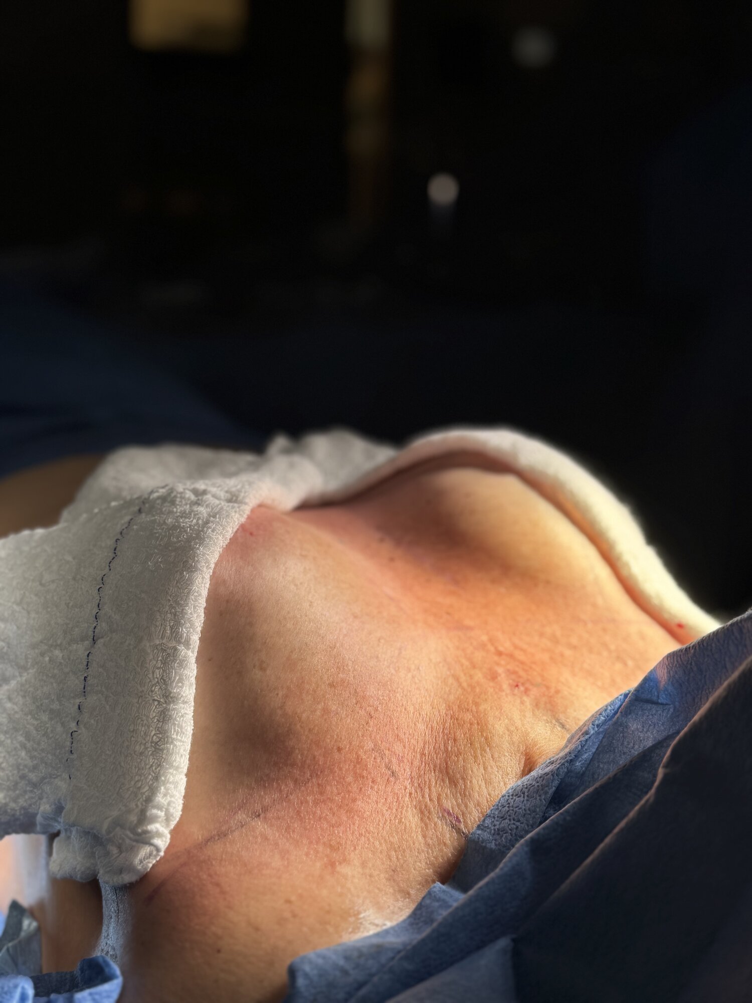 Mamoplastia de suspensão (mastopexia) — remodelagem e sustentação