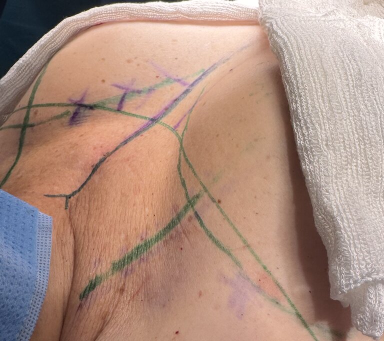 Mamoplastia redutora — marcação pré-operatória precisa